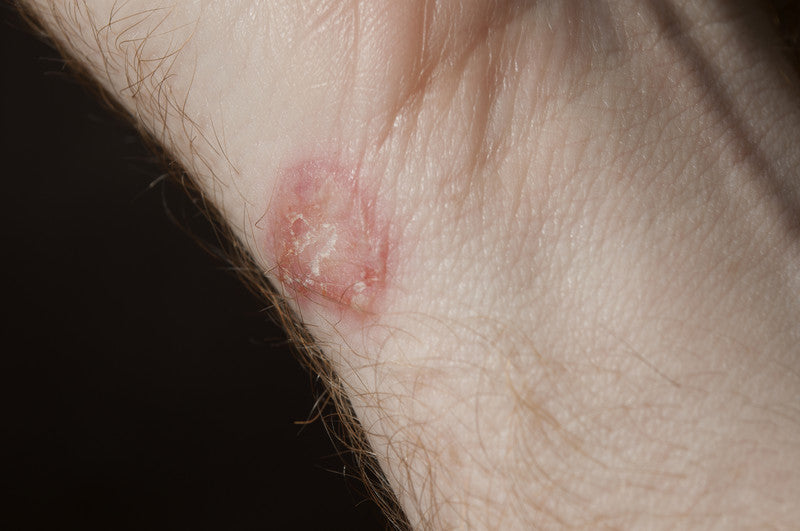 Close-up of a round red scaly ring-shaped fungal rash (ringworm) on the inner forearm