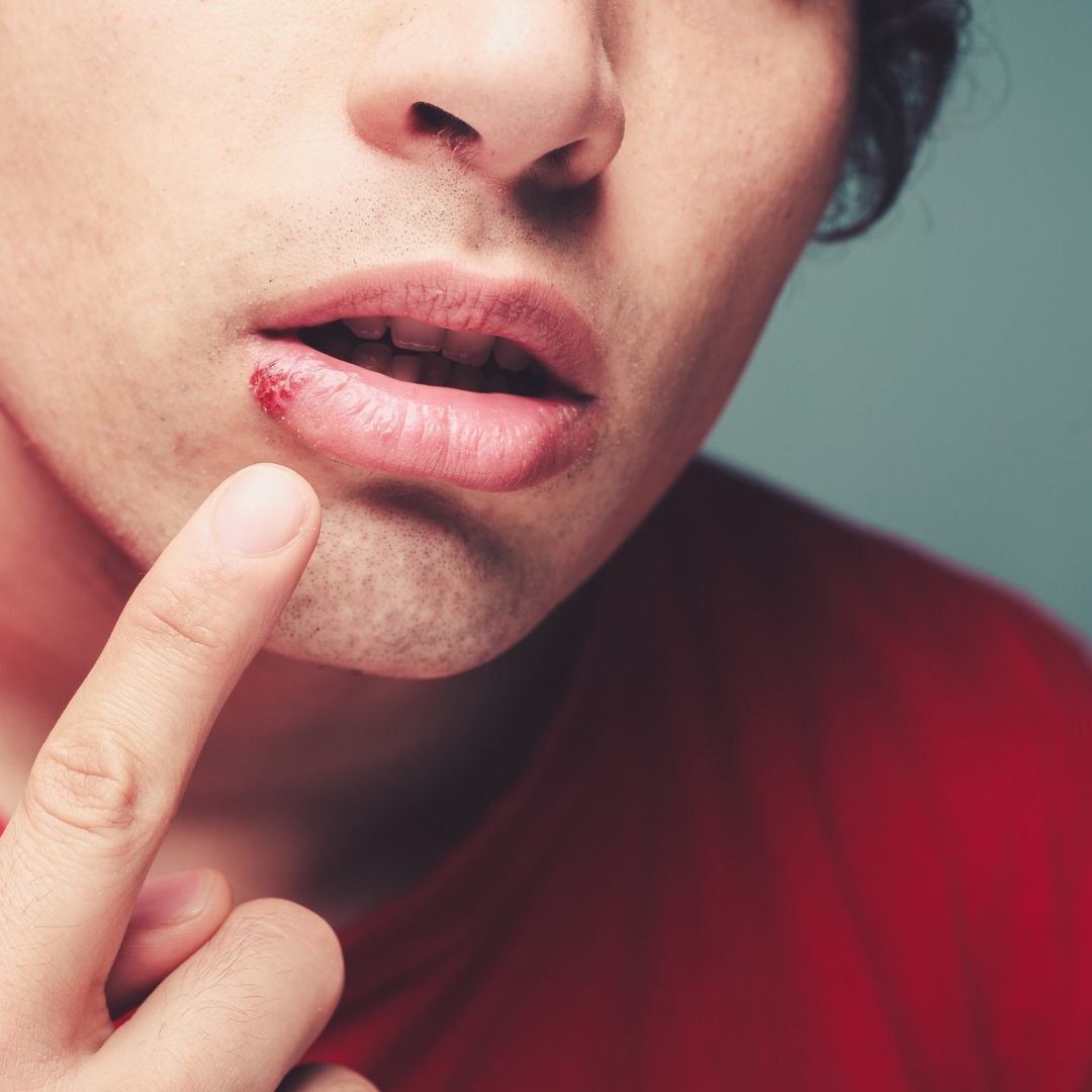Close-up of a person touching a painful cold sore on the lower lip
