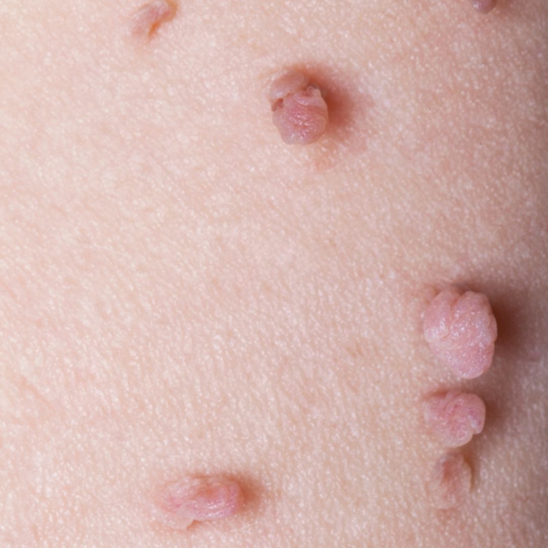 Close-up of multiple small flesh-colored skin tags on light-toned skin