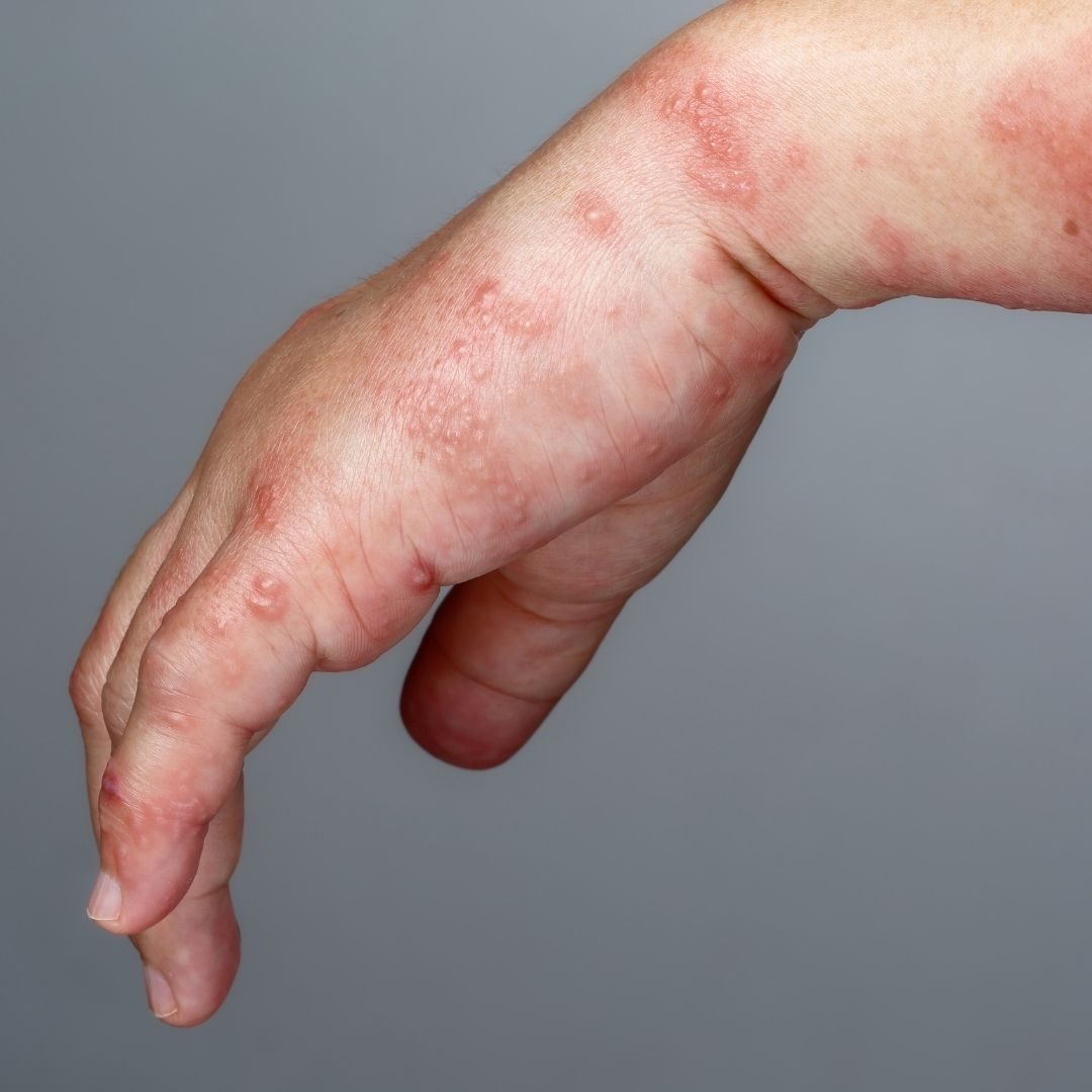 Close-up of a hand showing clustered blistering red rash from shingles on a gray background