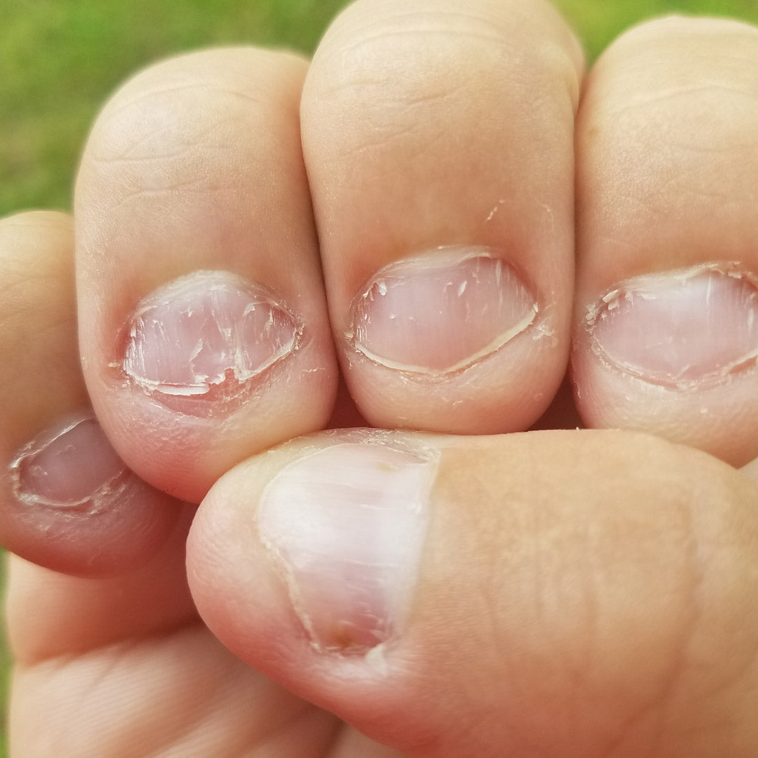 Fingernails showing peeling, brittle nail plates and damaged cuticles on a hand held against a blurred green background