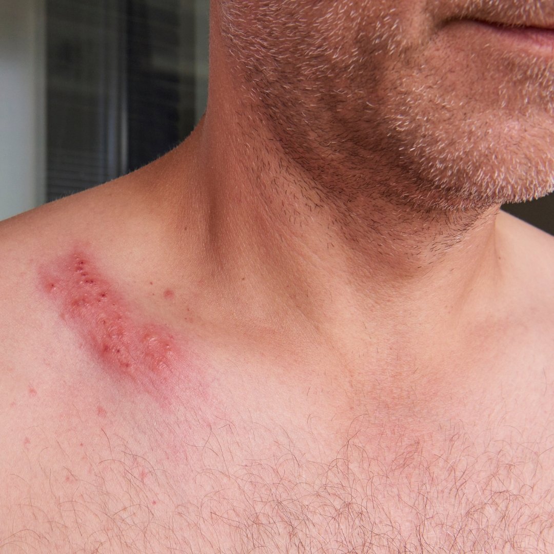Close-up of a man’s upper chest and shoulder showing a band of red blistering shingles rash near the collarbone