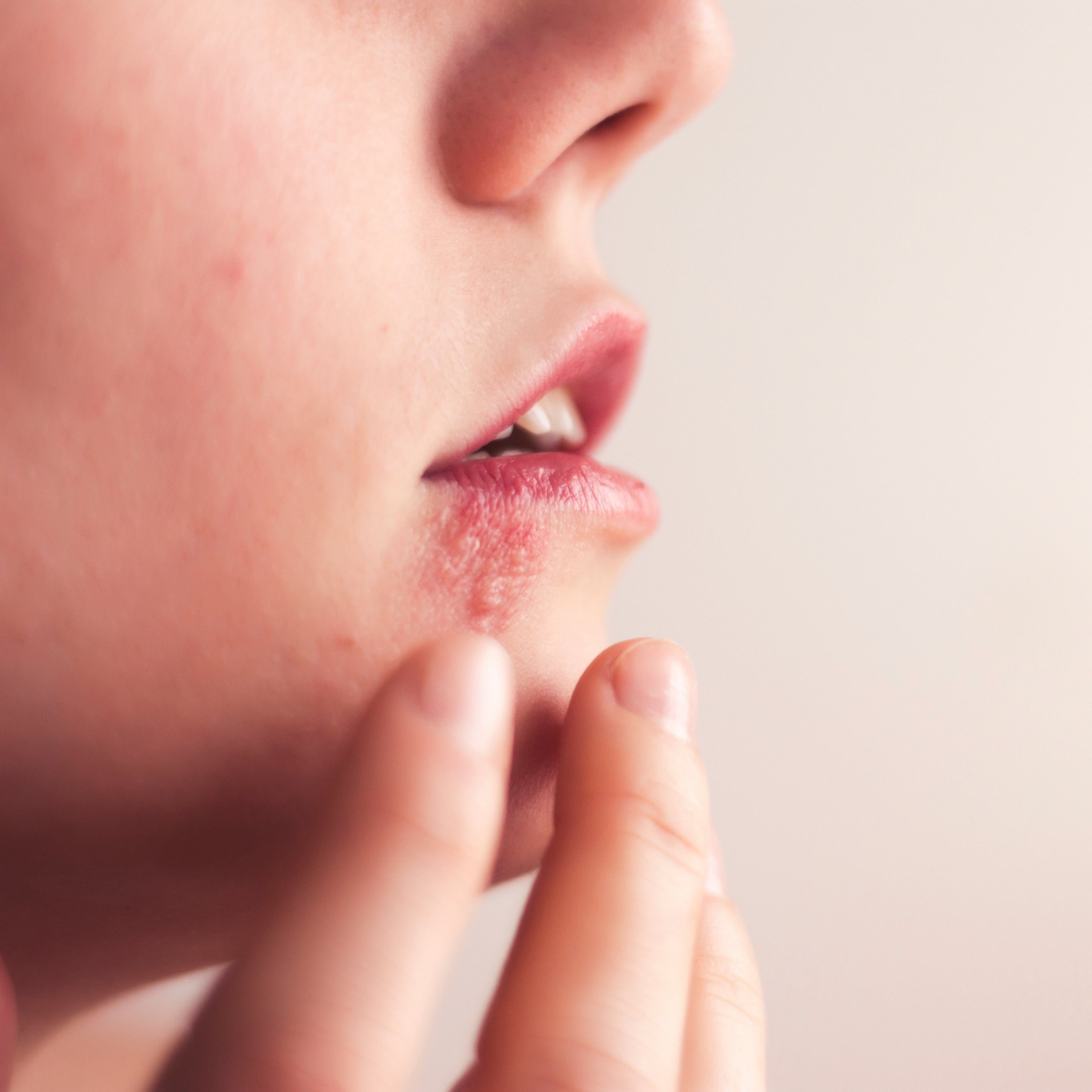 Close-up of a person’s lower face showing a cold sore on the lower lip with fingers touching the chin