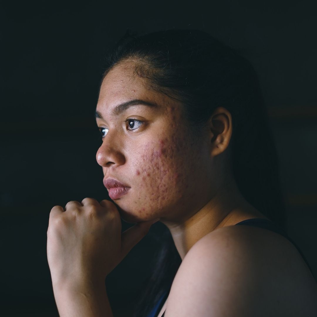 Young woman with acne on her cheek looking thoughtful in a low light portrait