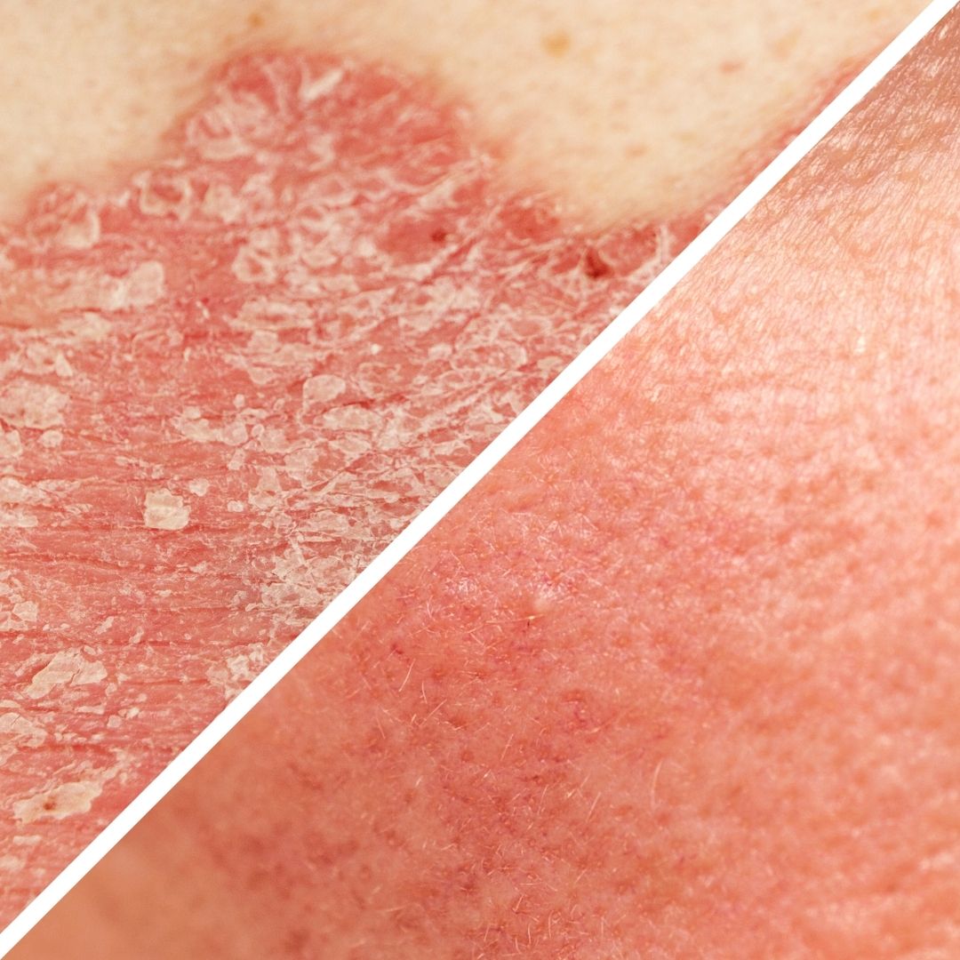 Close-up comparison showing scaly, flaky psoriasis plaque on the left and red, inflamed rosacea-affected skin on the right