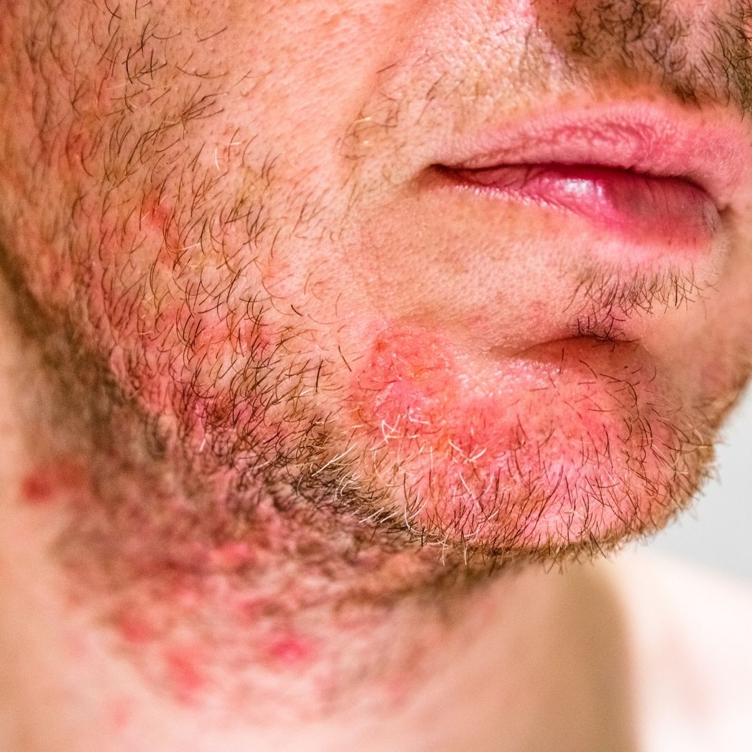 Close-up of a man’s lower face showing red, scaly rash and dry, flaky patches on the chin and jawline