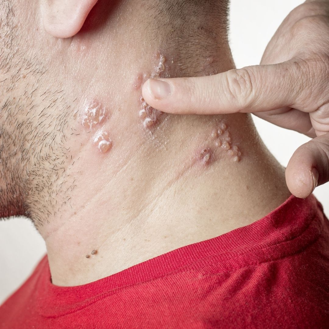 Close-up of a person’s neck showing clustered blistered shingles rash with a finger pointing at the lesions