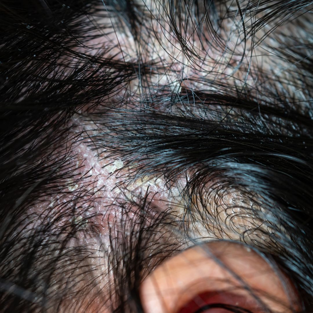 Close-up of a scalp with red inflamed patches, thick scaly plaques and white flaking skin near the ear