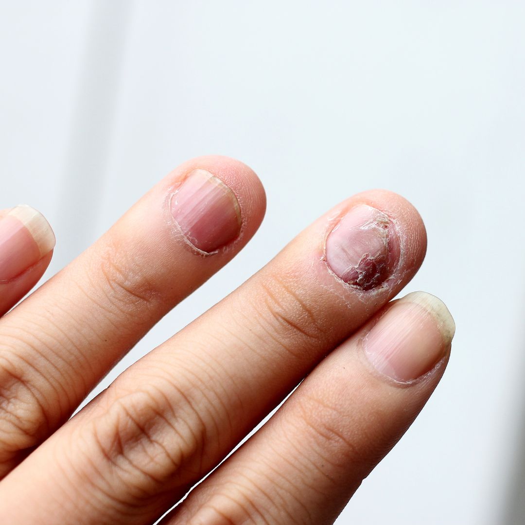 Close-up of three fingernails showing nail psoriasis with pitting, flaking cuticles, brownish discoloration, and nail plate damage