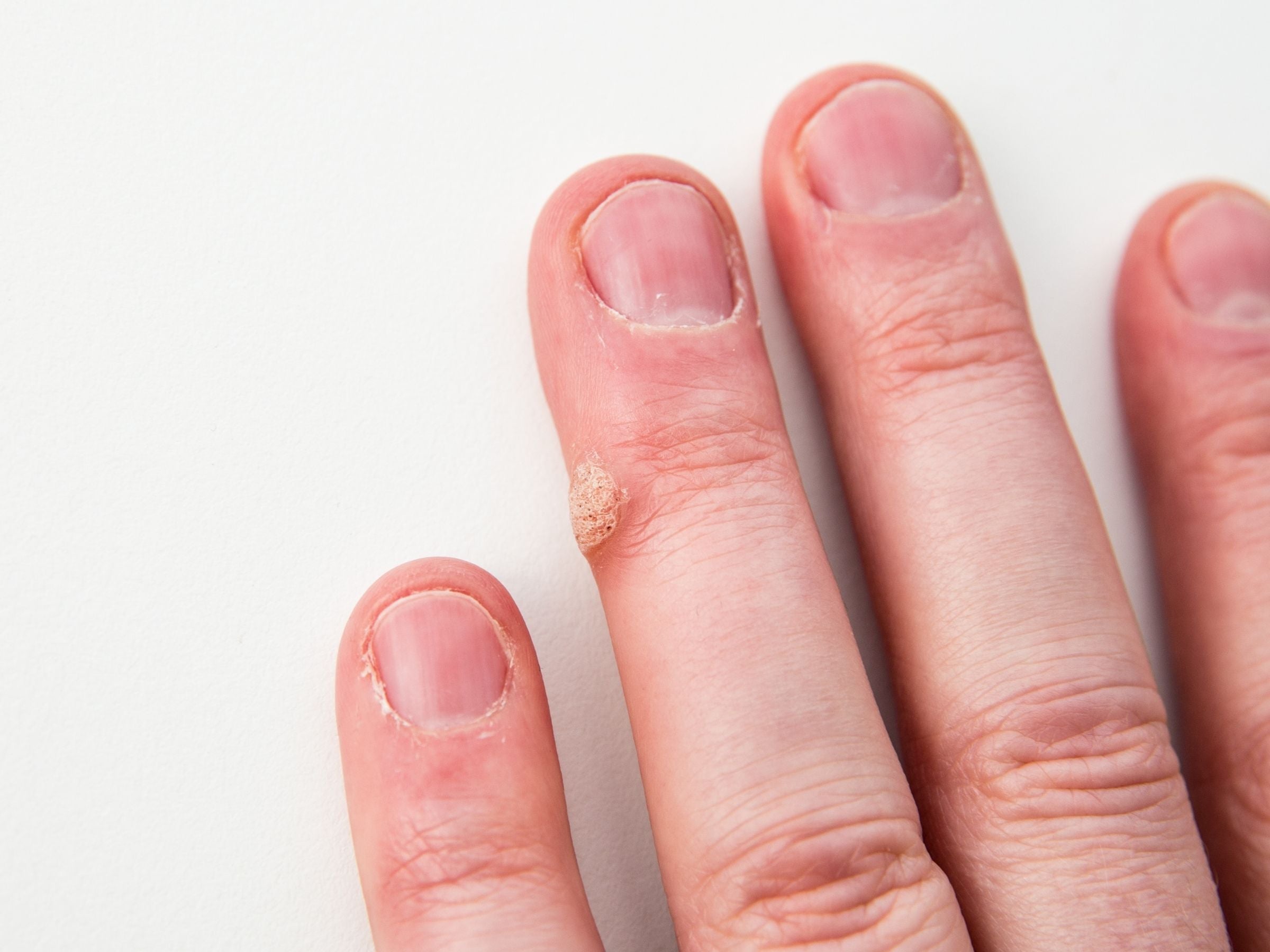 Close-up of three fingertips showing a small rough wart on the side of one finger against a white background