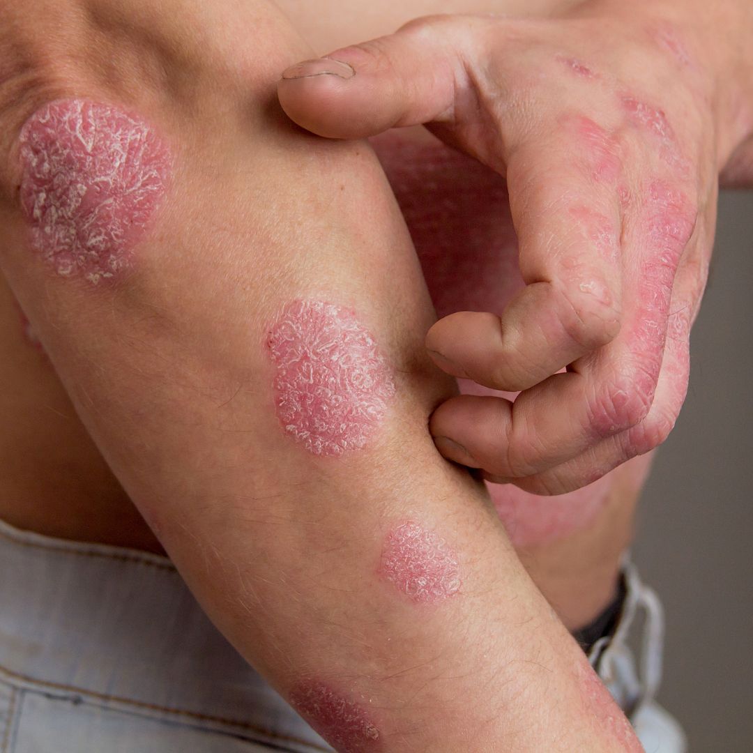 Close-up of a forearm and hand showing round, scaly red plaques of plaque psoriasis with the person touching an affected area