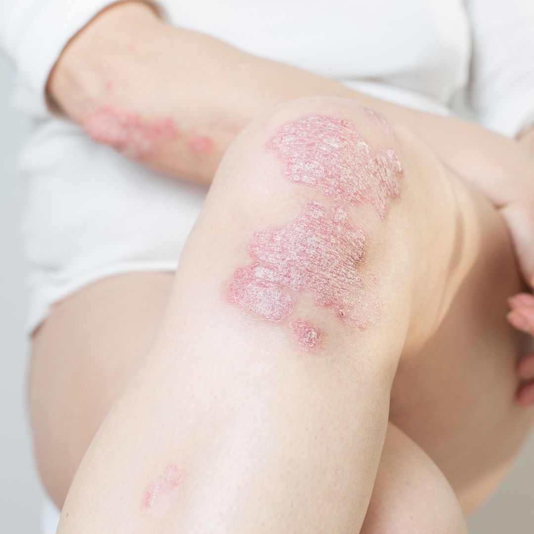Close-up of a person’s knee and forearm showing red, scaly plaque psoriasis lesions on pale skin