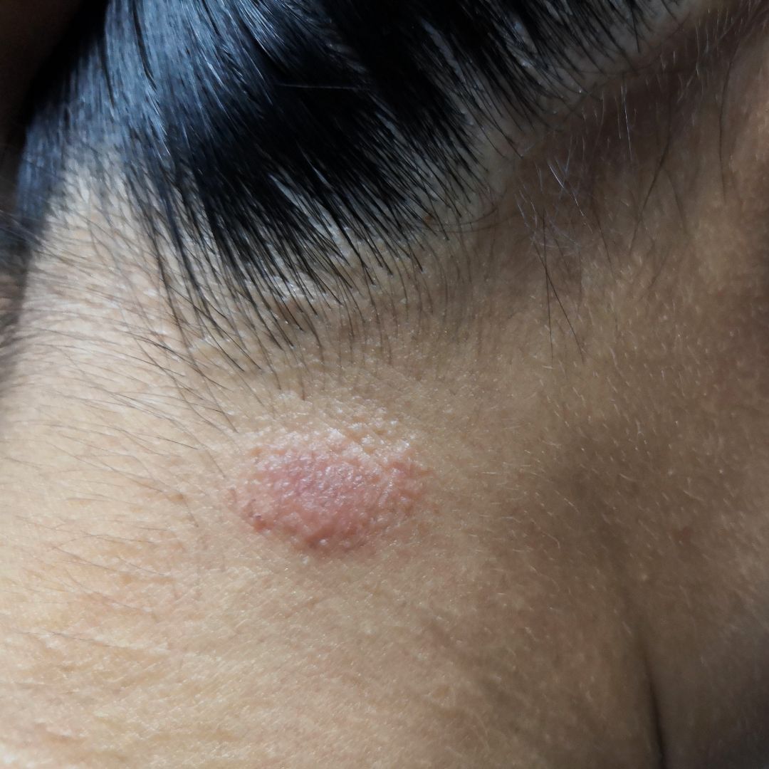 Close-up of hairline showing a round pink scaly patch on the scalp consistent with ringworm