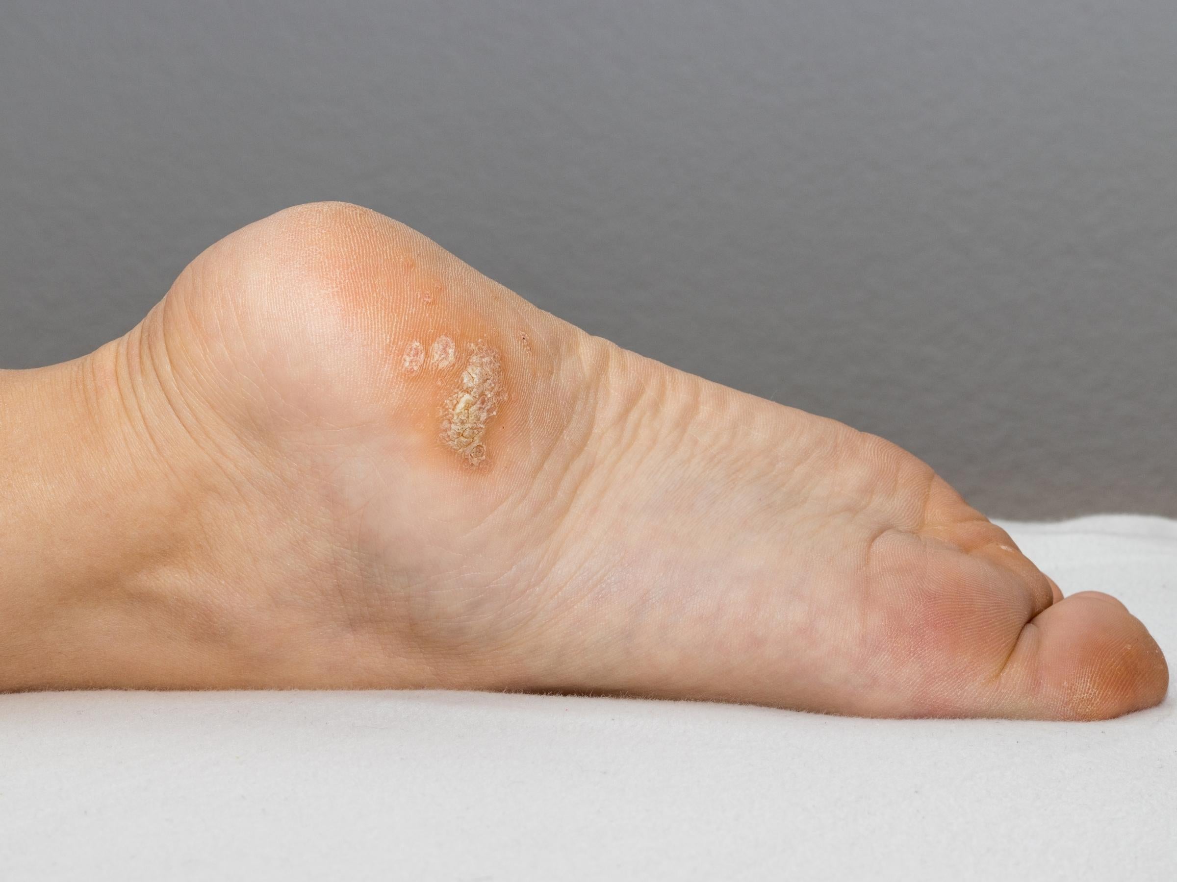Close-up of the ball of a foot showing a crusty plantar wart against a neutral gray background
