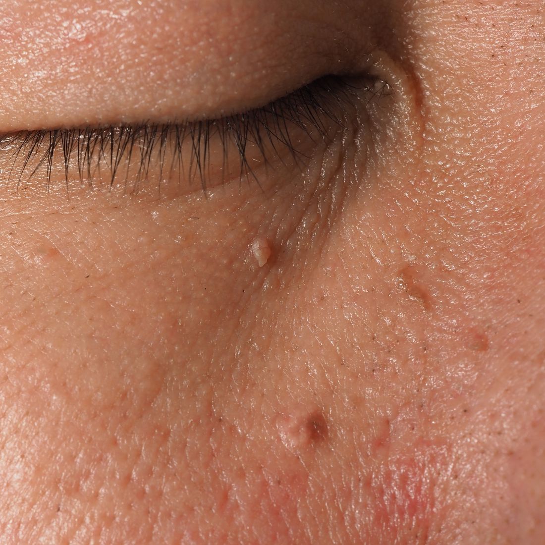 Close-up of skin near a closed eye showing small flesh-colored skin tags on the cheek
