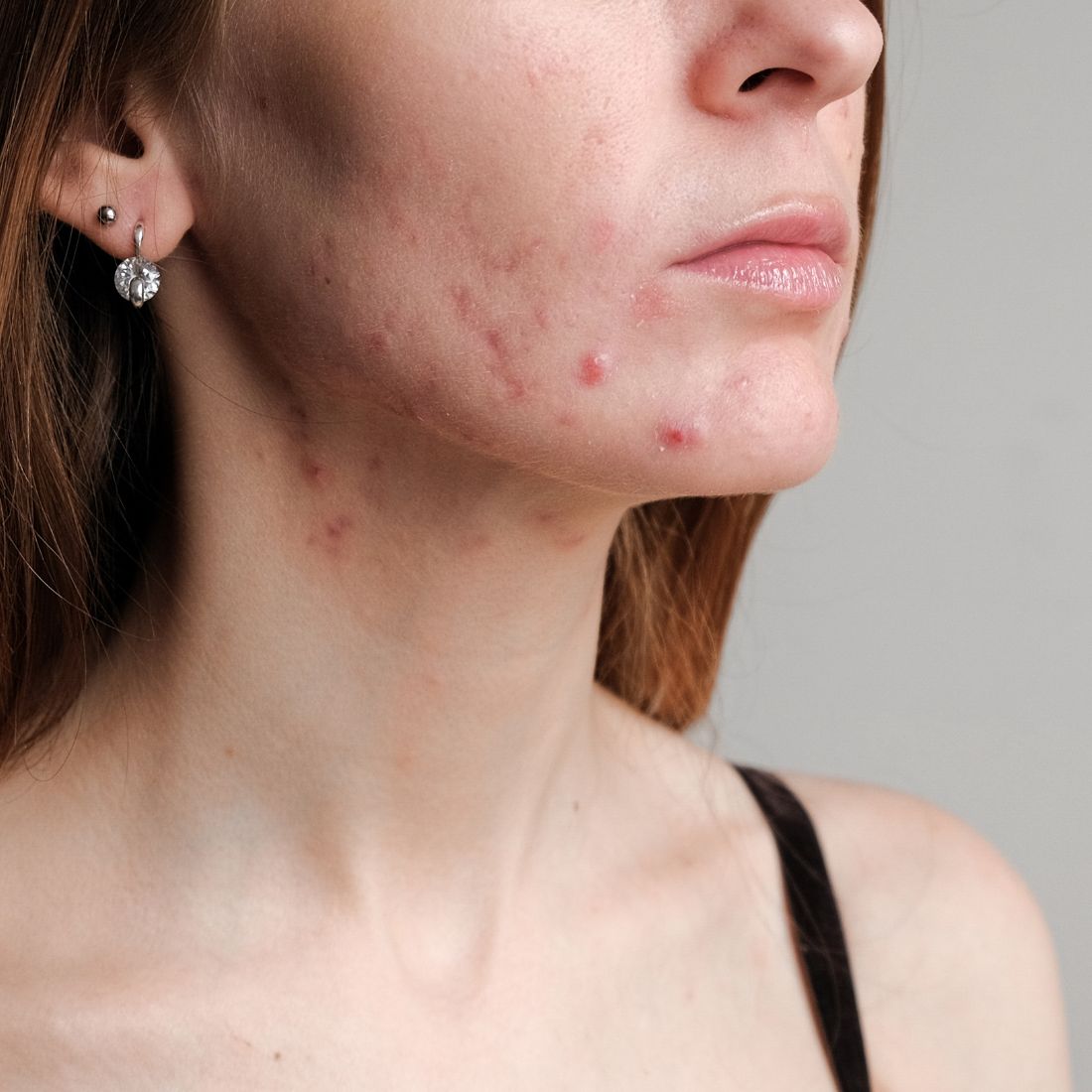 Close-up of a young woman with red, inflamed acne along her jawline and chin against a neutral background