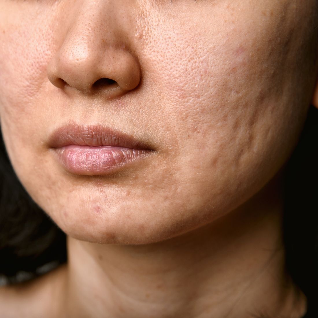 Close-up of lower face showing ice-pick acne scars and pitted, uneven skin texture on the cheek and chin