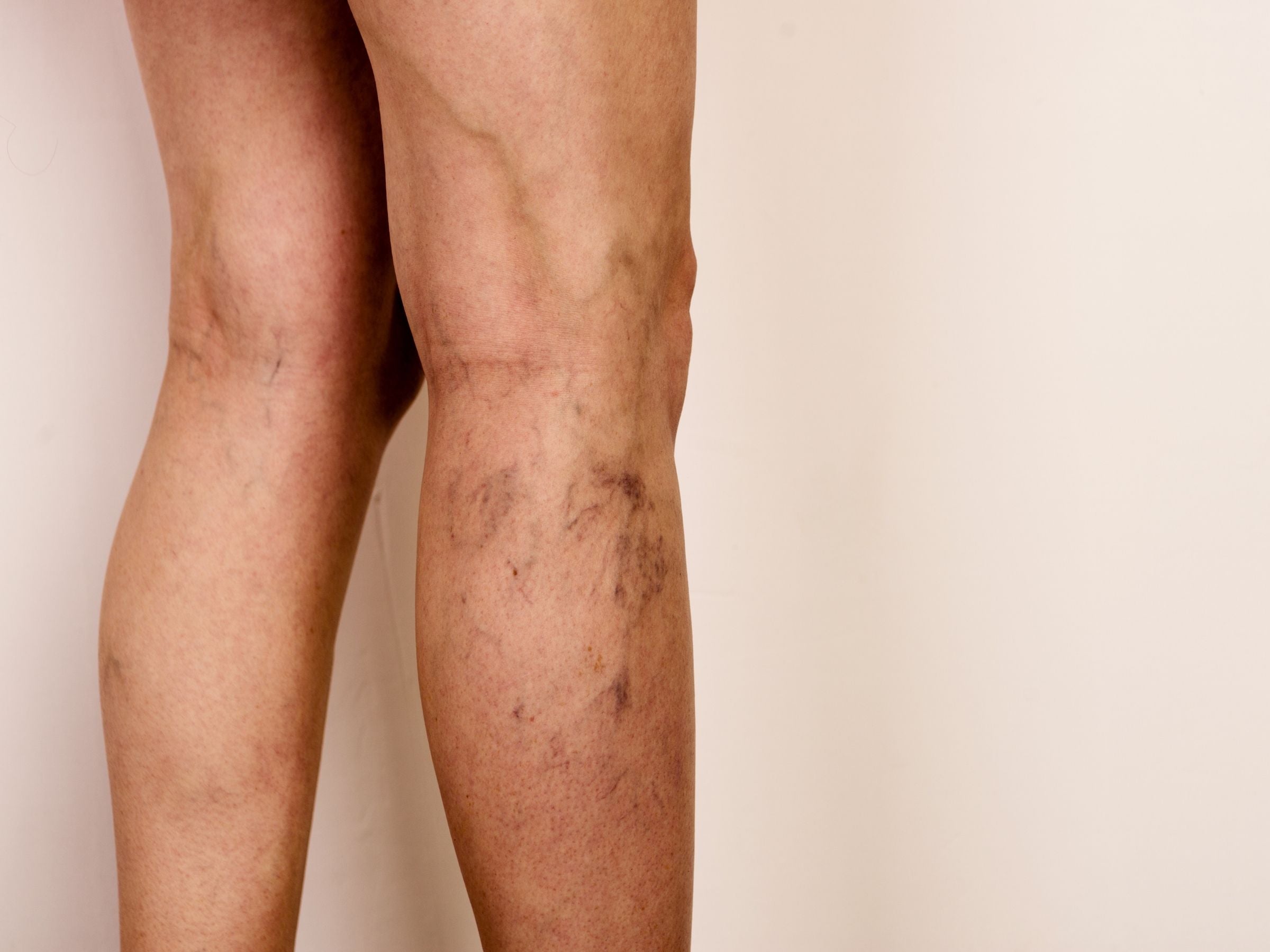 Back of lower legs showing purple and blue spider veins on calves and ankles against a pale beige background
