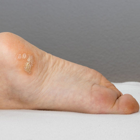 Plantar Warts on Foot