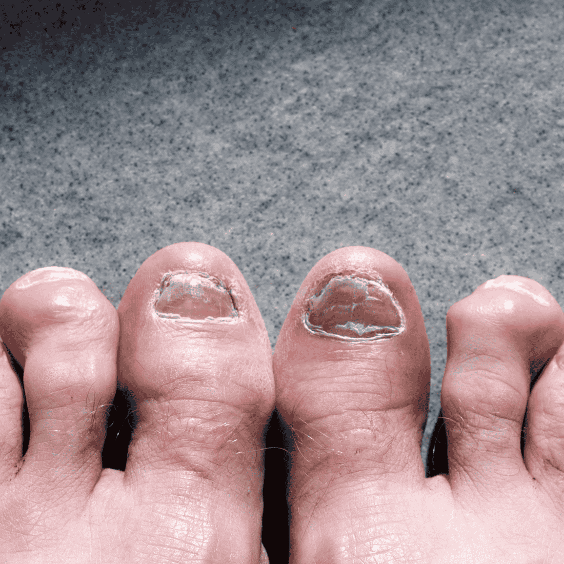 7 Myths & Misconceptions Around Nail Fungus