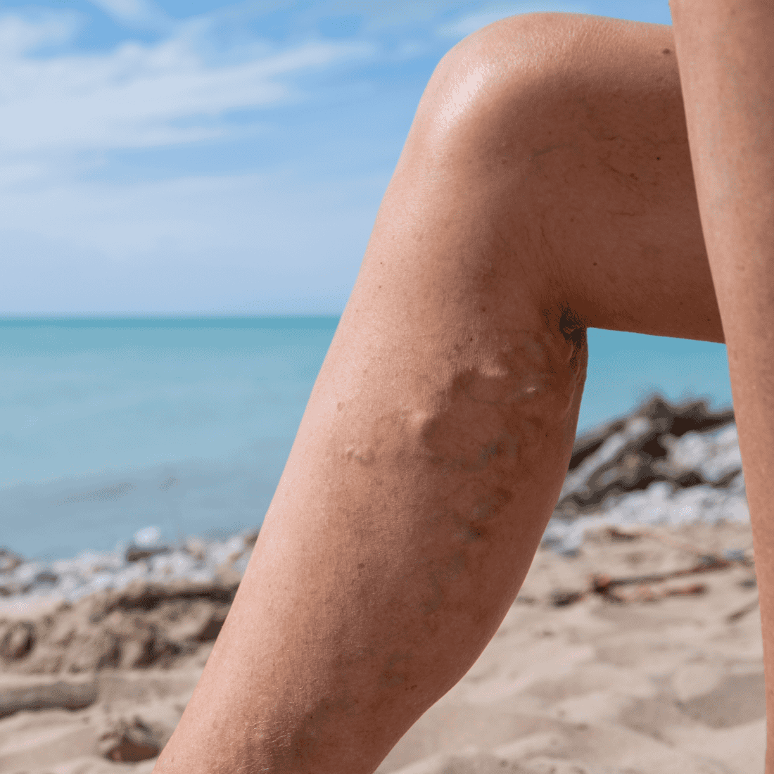 Varicose Veins and Summer: How to Keep Your Legs Looking and Feeling Great