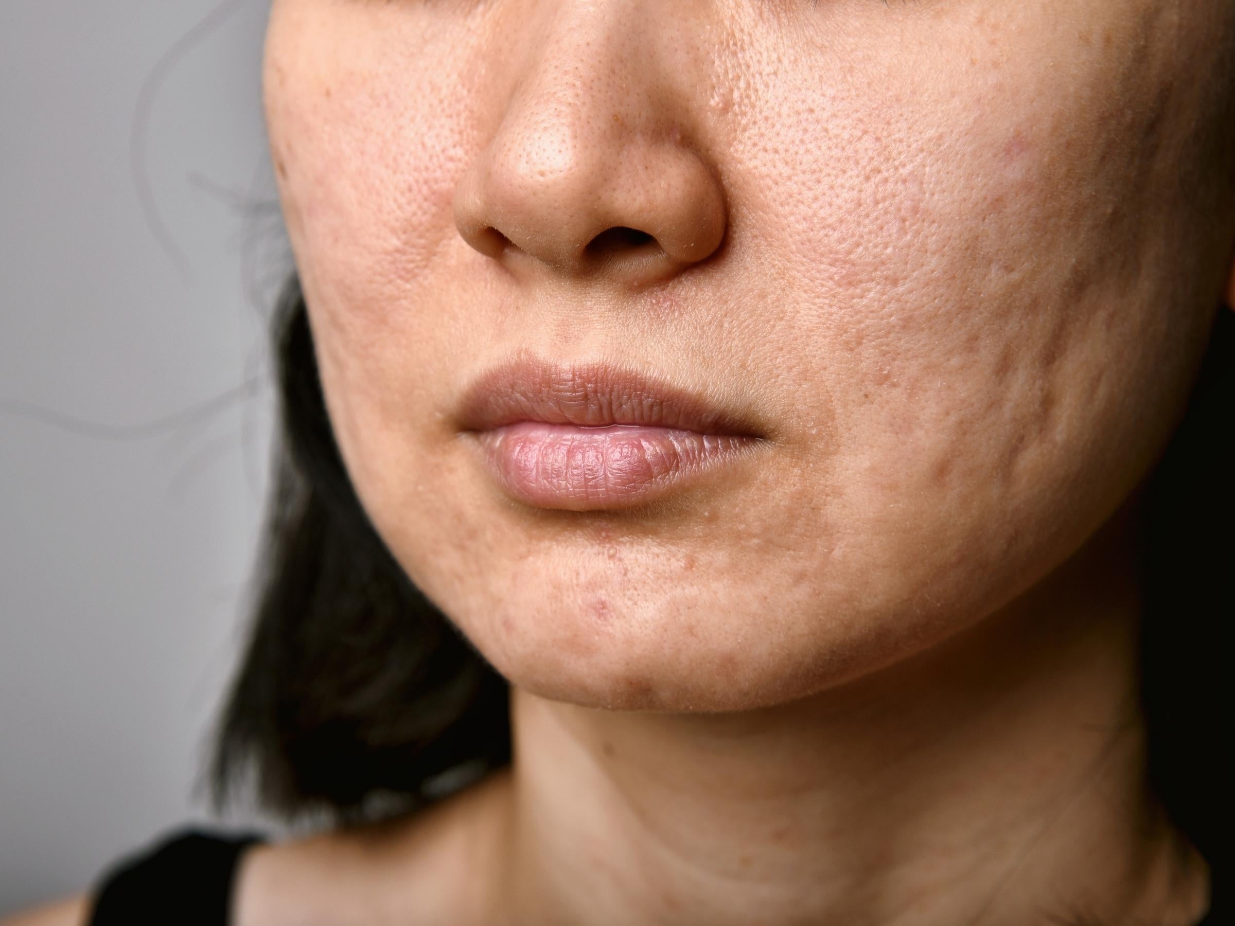 Close-up of lower face showing ice-pick acne scars and pitted, uneven skin texture on the cheek and chin