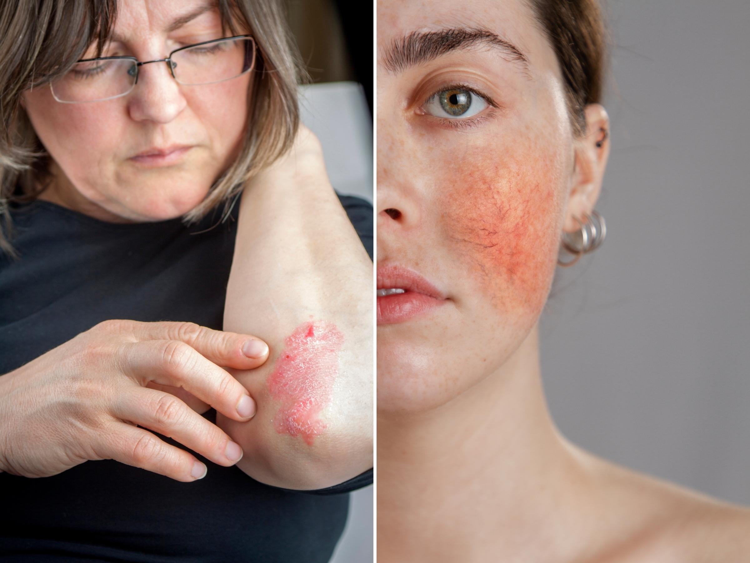 Comparison of a woman with psoriasis on her arm verse a woman with rosacea on her cheek