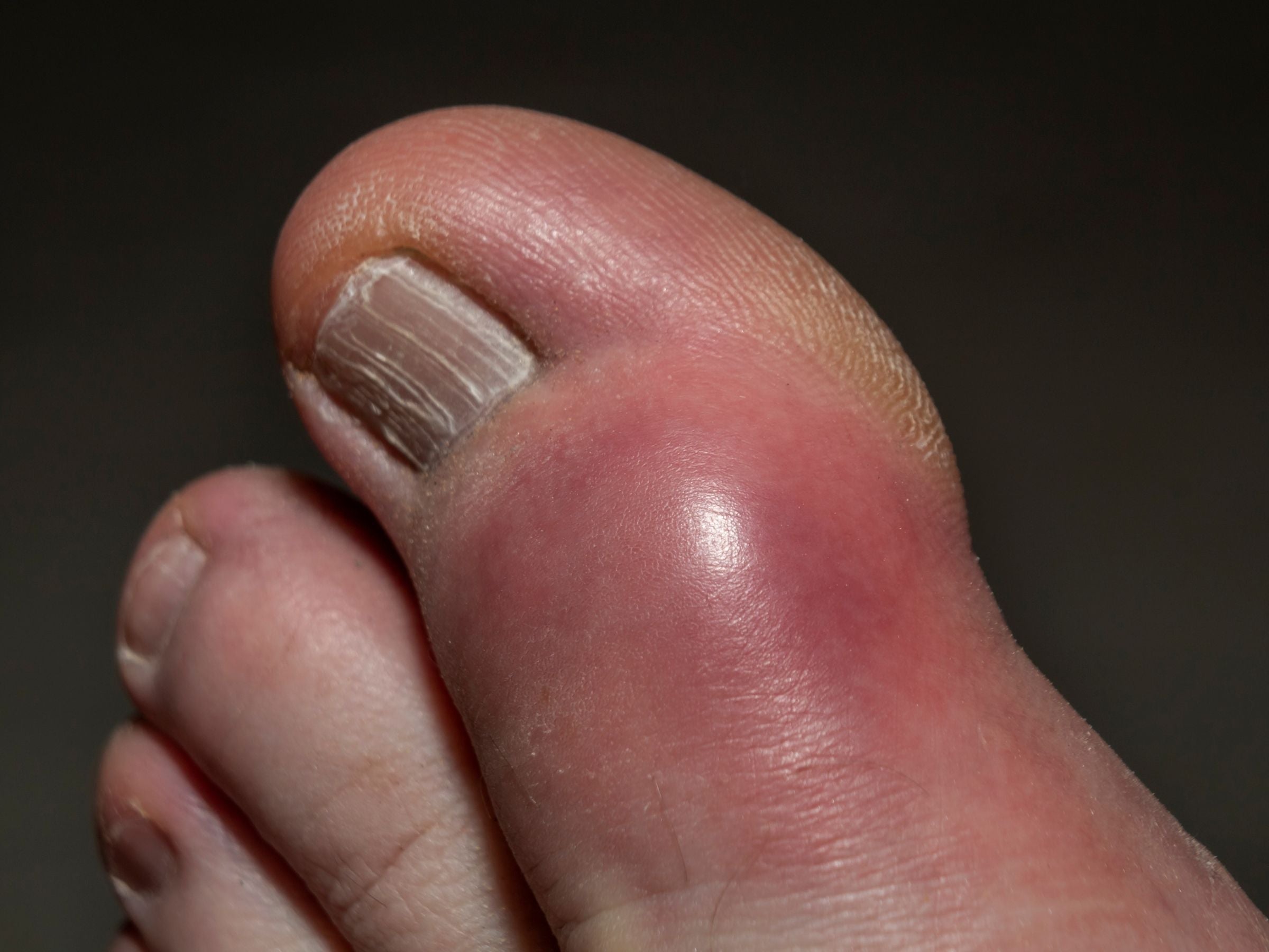 Defining Gout and Exploring Treatment Options