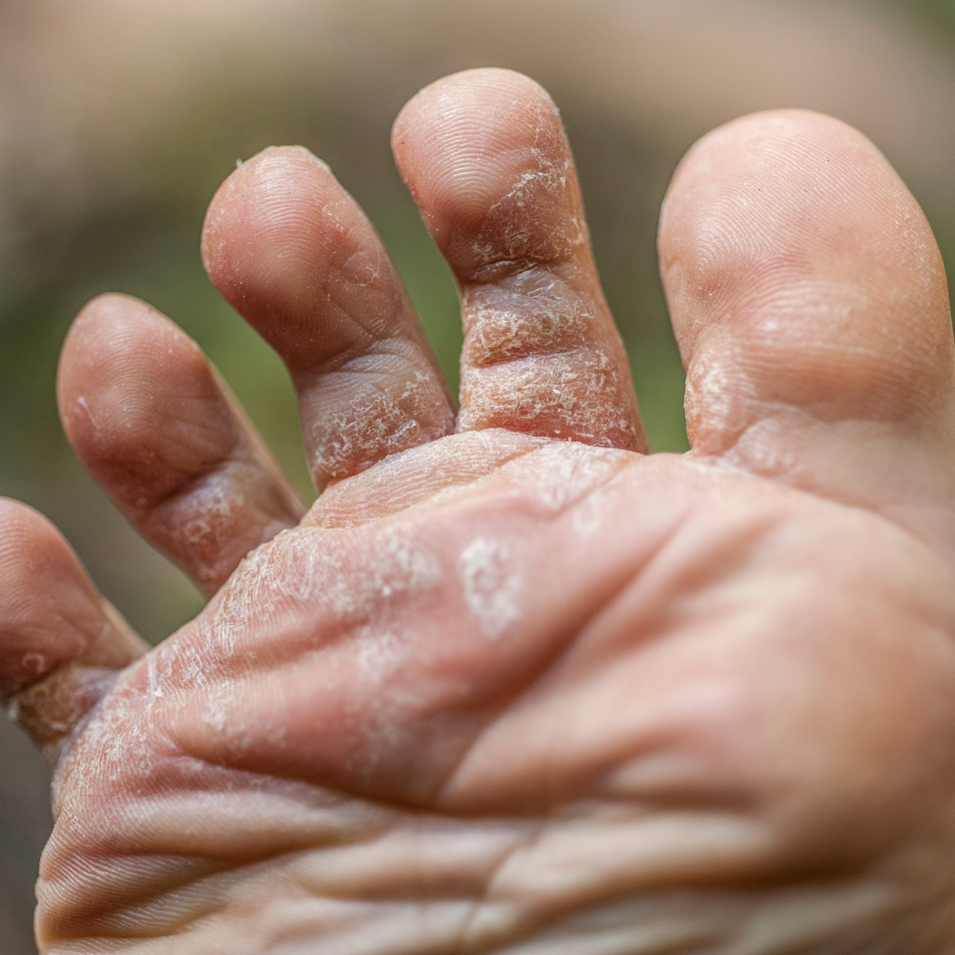 A Natural Remedy for Athlete’s Foot