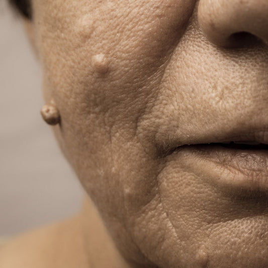 What is a wart?