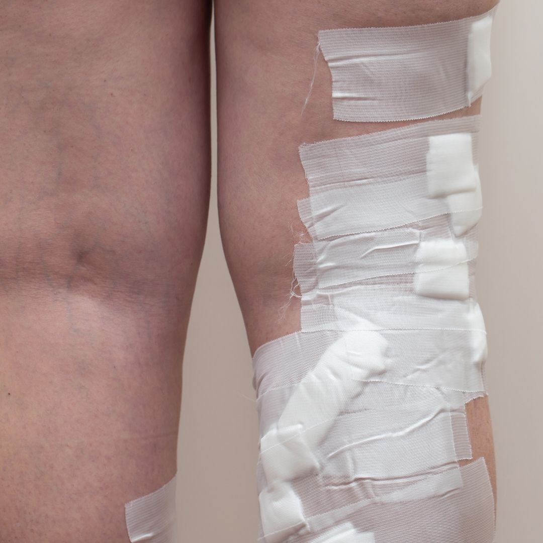 What is Sclerotherapy for varicose veins