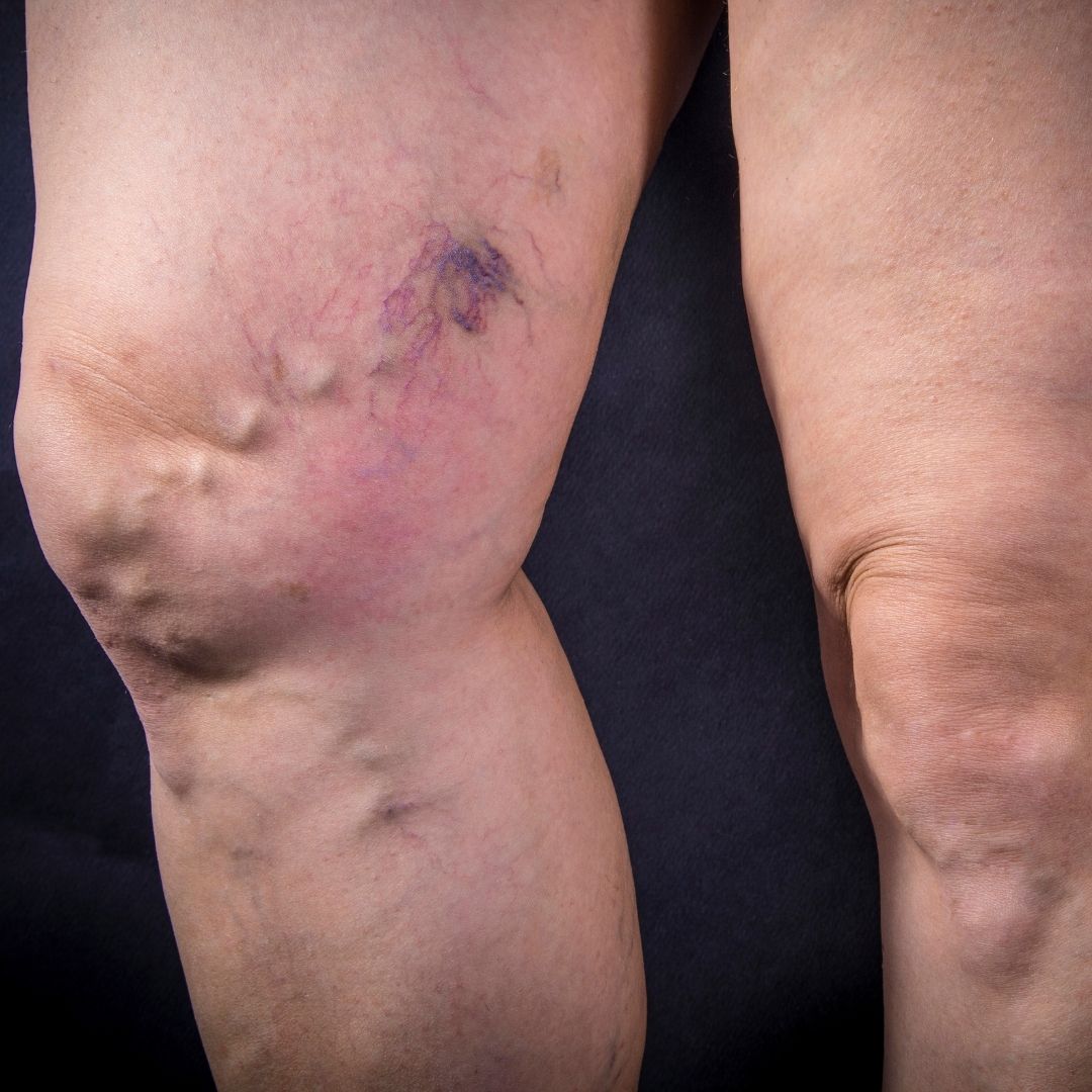 Varicose Veins and Spider Veins