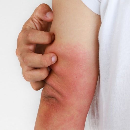 Itchy Eczema Elbow