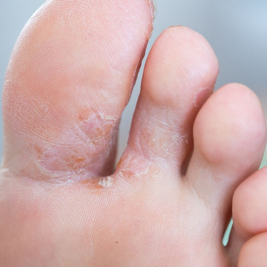 Cracking Foot with Athlete's Foot Fungus