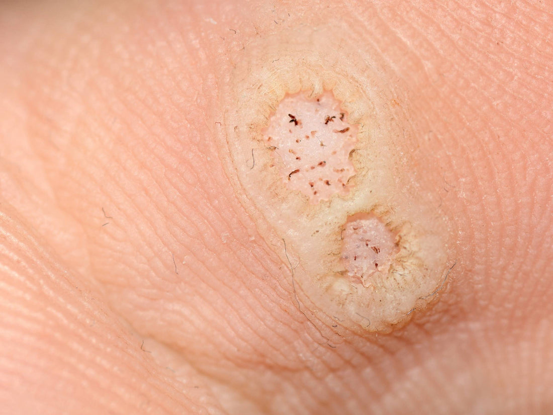 Close-up of an older person’s lower face showing multiple raised flesh-colored warts on the cheek and near the mouth