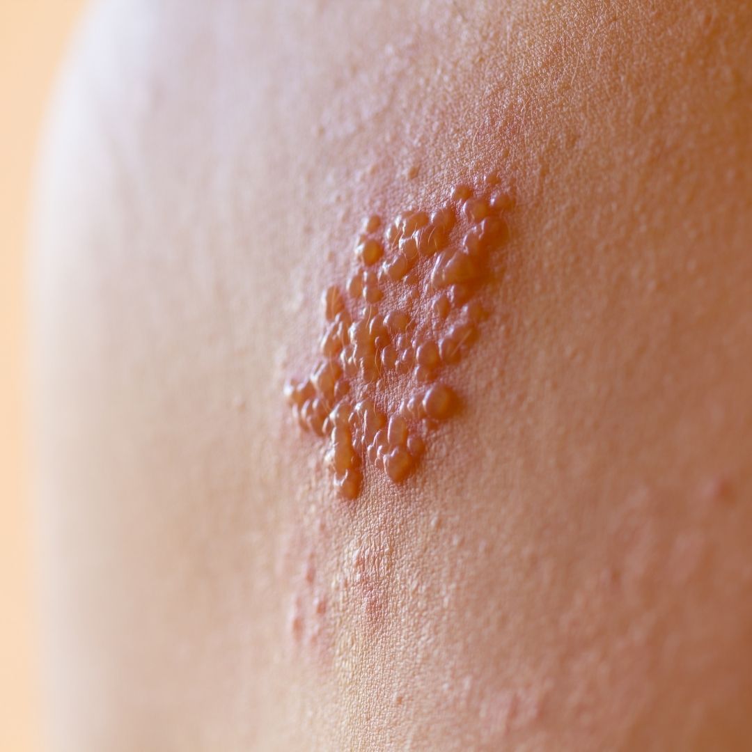Close-up of skin showing a cluster of raised, fluid-filled blisters consistent with shingles