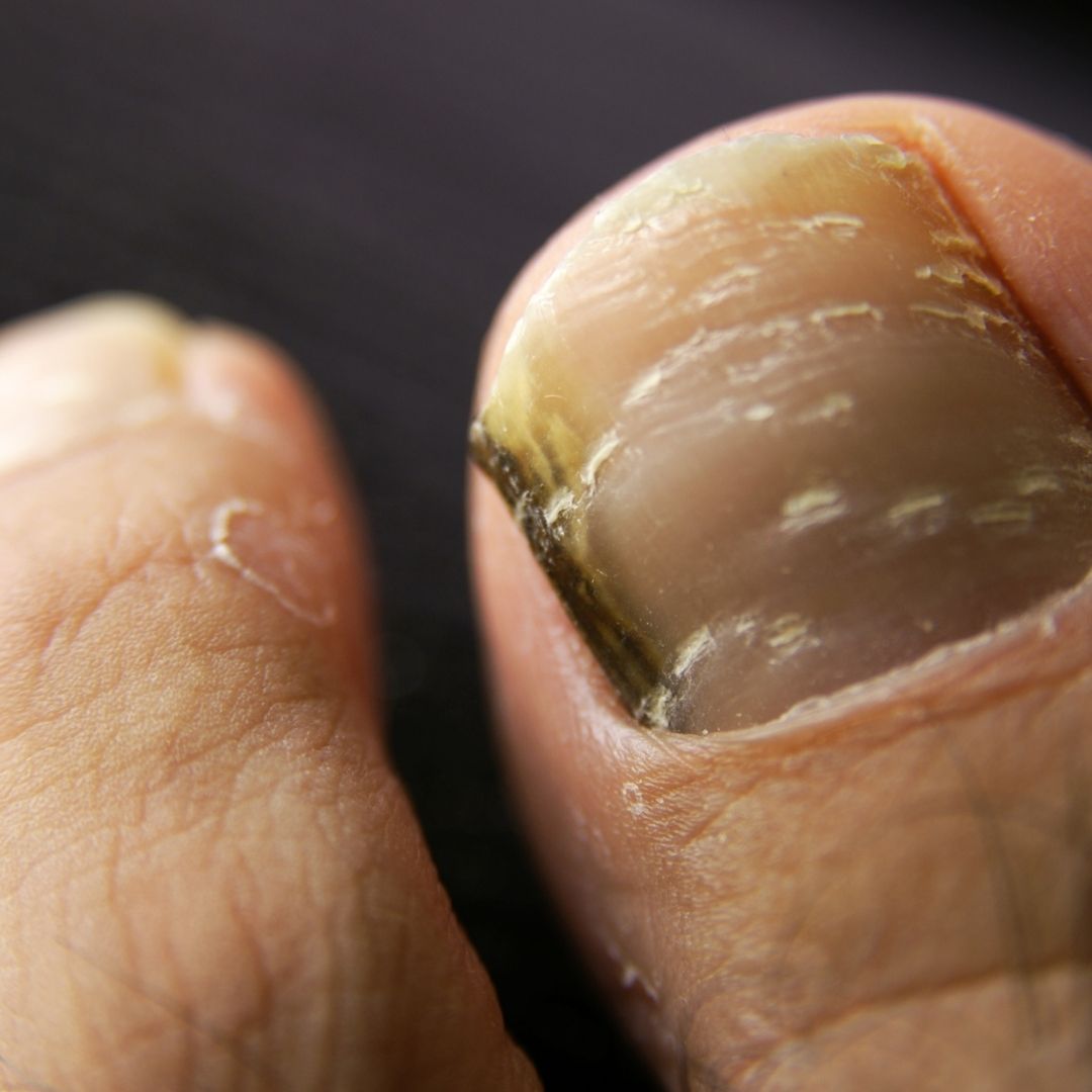 Close-up of a big toe with a thick, darkened and yellowed toenail showing signs of fungal infection against a dark background