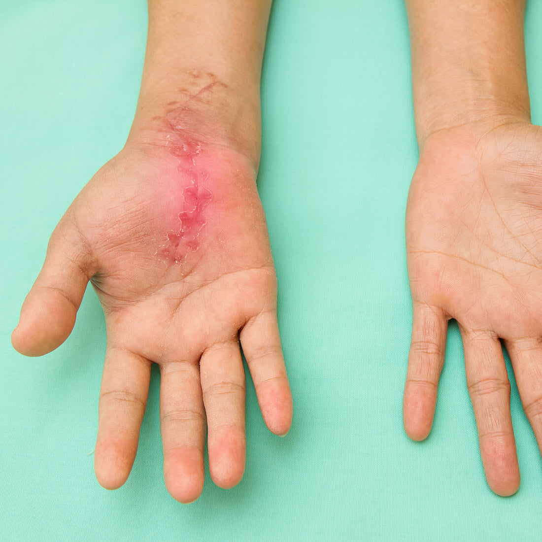Child’s left palm showing a raised pink healing scar from wrist toward the center of the hand on a mint green background