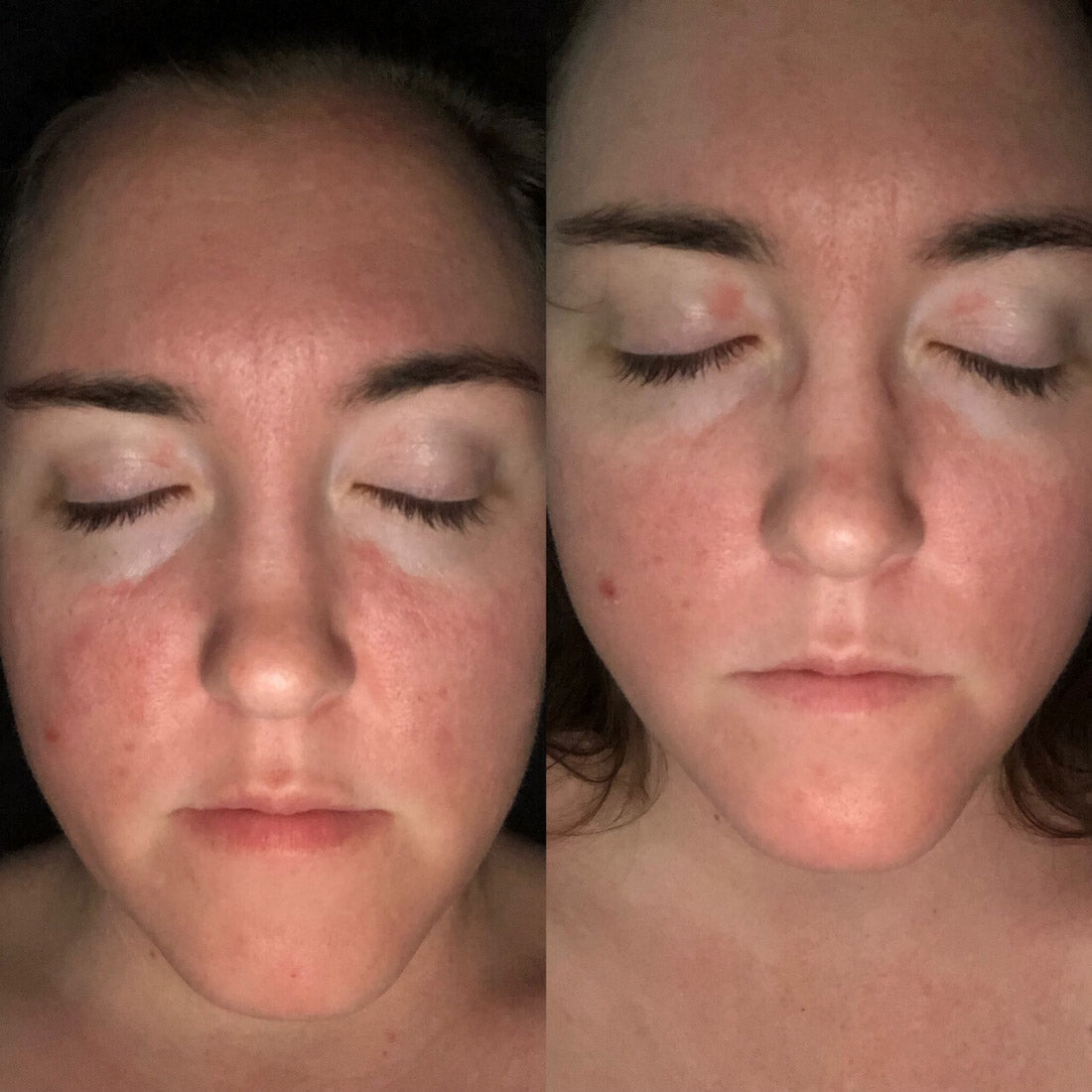 Woman with eyes closed showing red, scaly plaque psoriasis on cheeks, nose, and forehead against a dark background