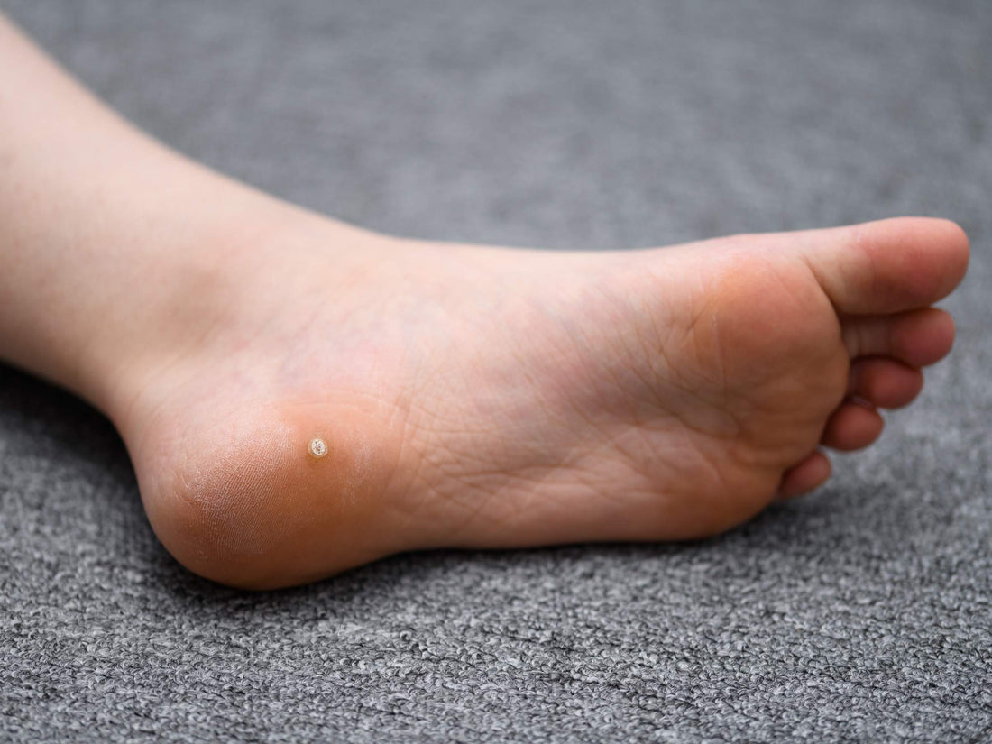 Sole of a foot showing a small circular plantar wart on the ball of the foot resting on a gray carpet