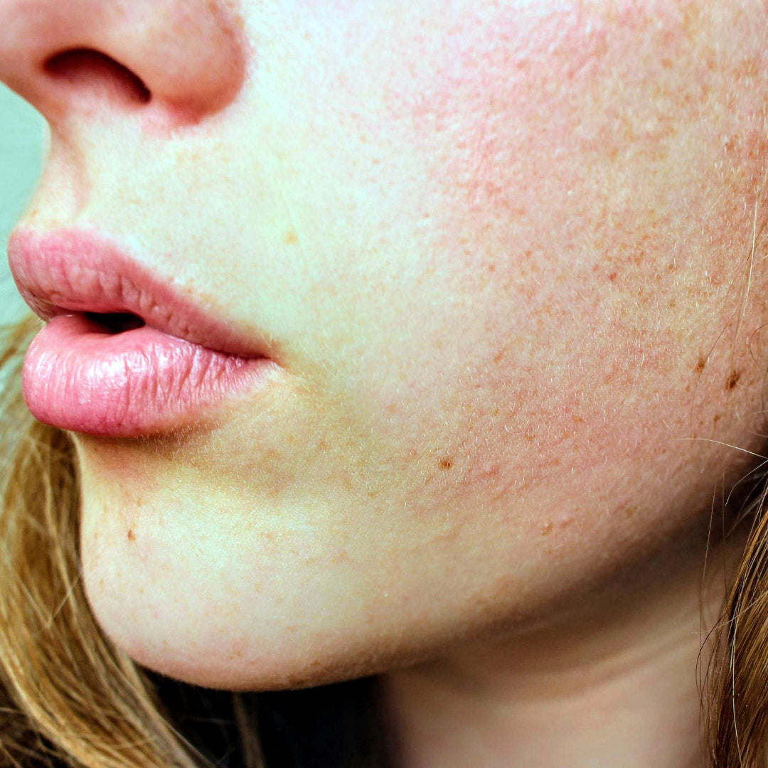 Lower face of person with rosacea showing diffuse cheek redness, visible small bumps, and enlarged pores near the mouth