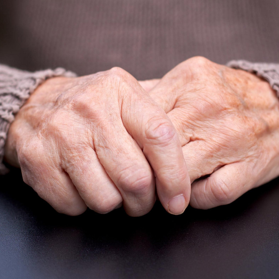 Older adult’s hands resting on a dark surface, showing enlarged knuckles and bony joint deformities