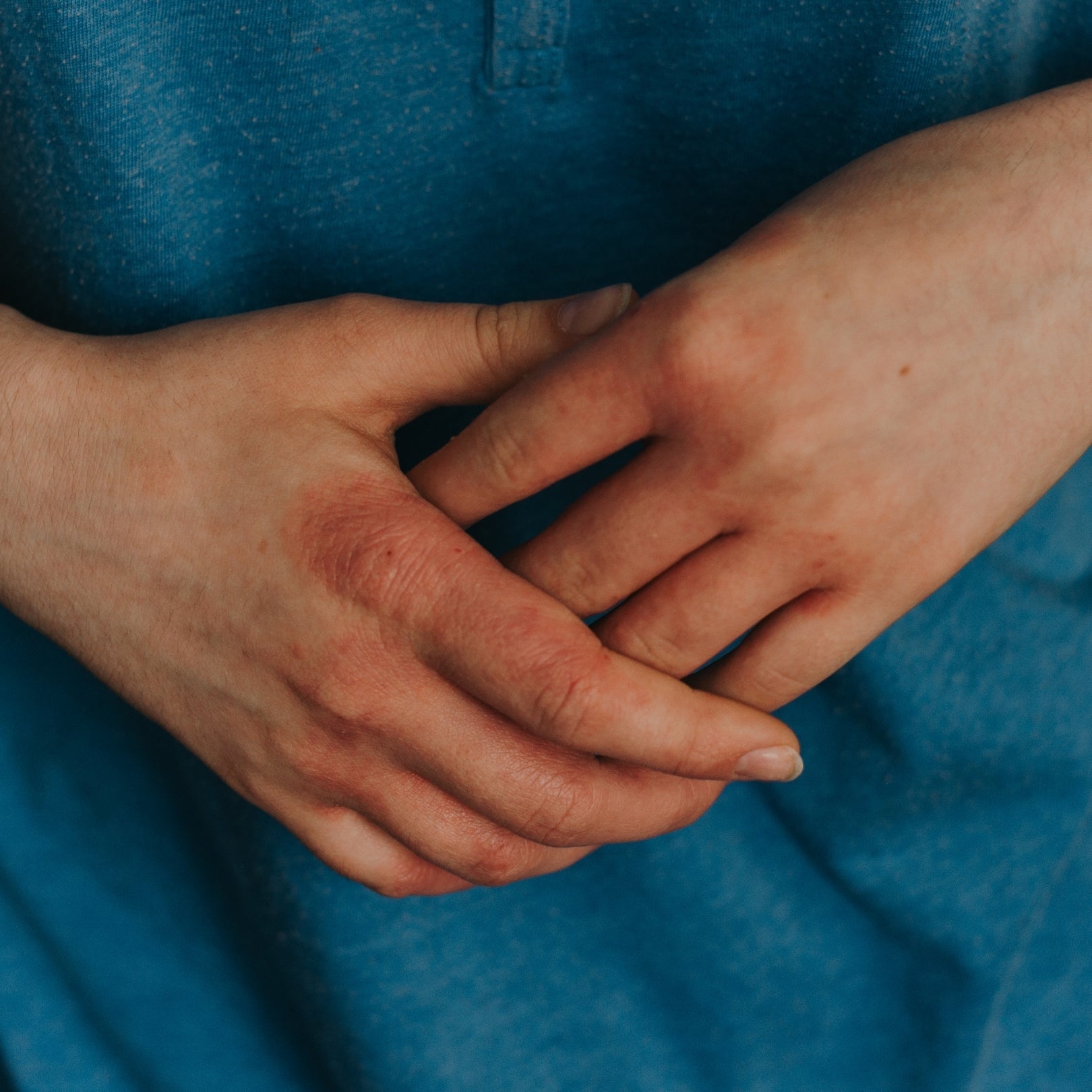 Close-up of hands showing red, dry eczema patches on the knuckles against a blue shirt