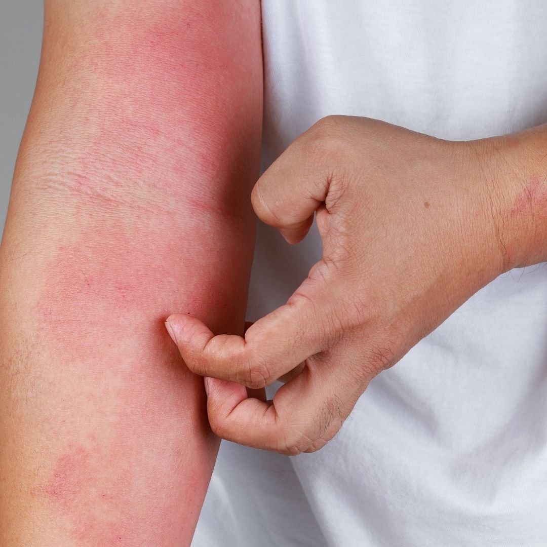 Close-up of person scratching a red, inflamed forearm rash against a white shirt