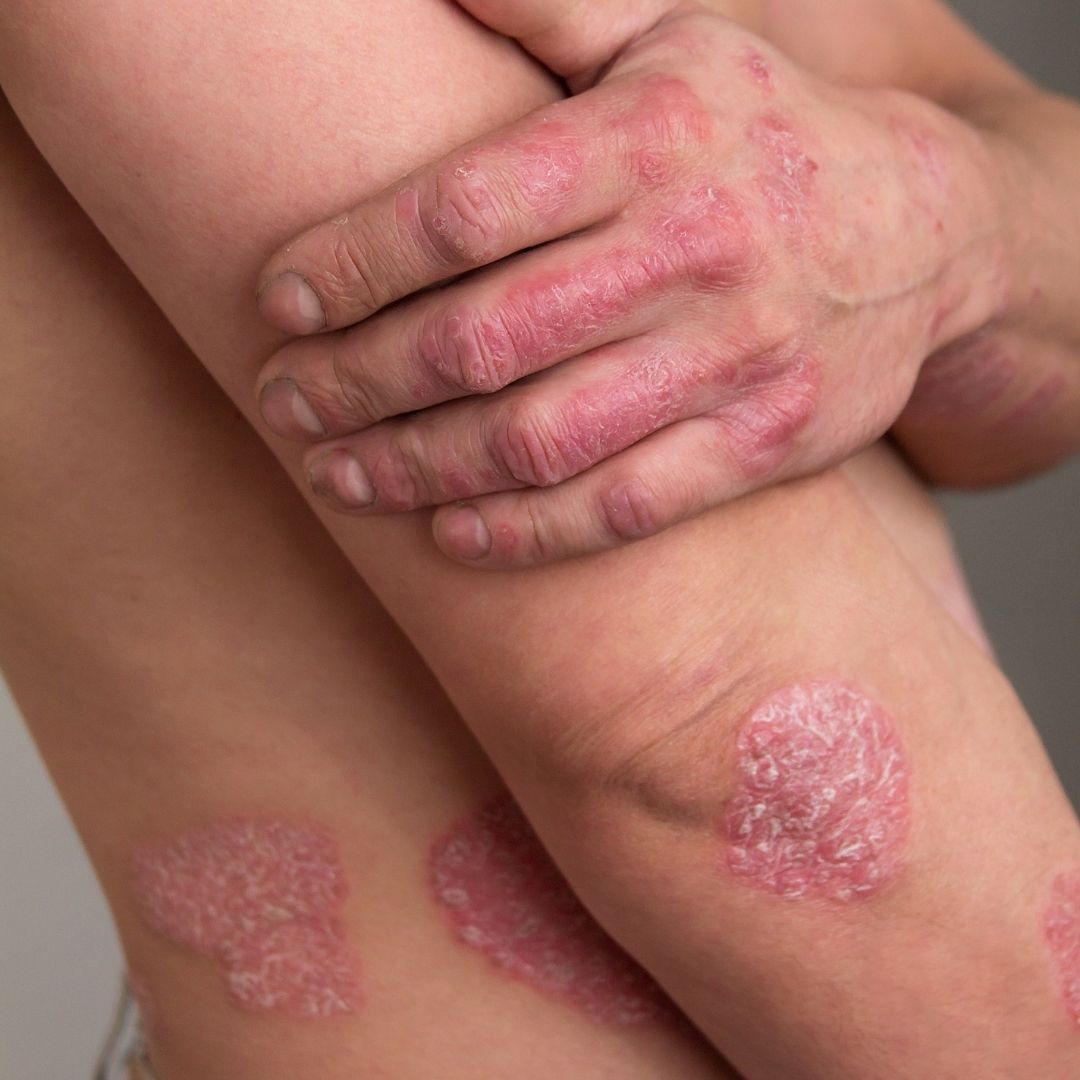 Close-up of a person’s hands and bent knee showing red, scaly psoriasis plaques and cracked, inflamed skin