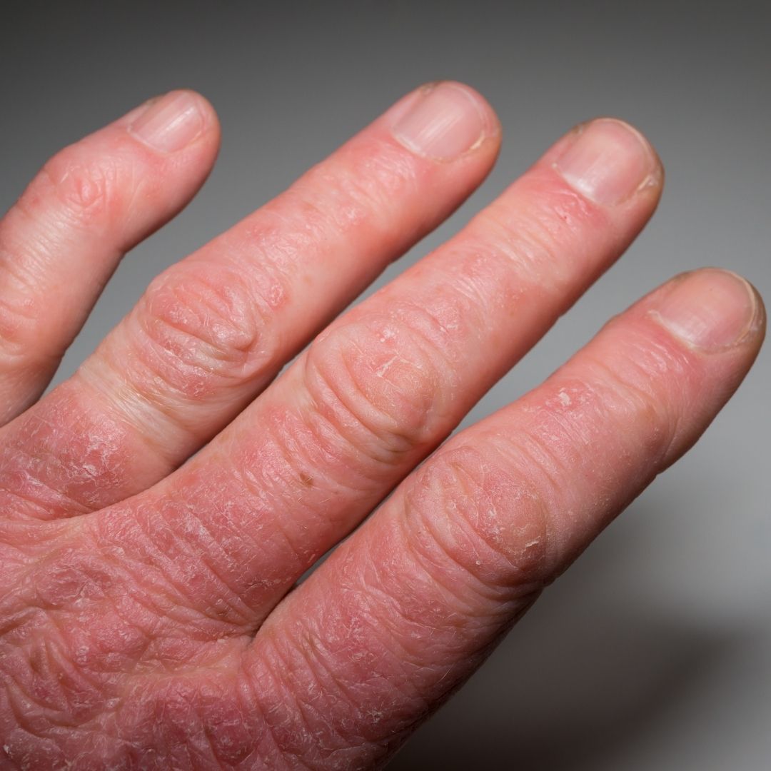 Close-up of a hand with red, scaly, dry, cracked skin on the fingers illustrating psoriatic arthritis