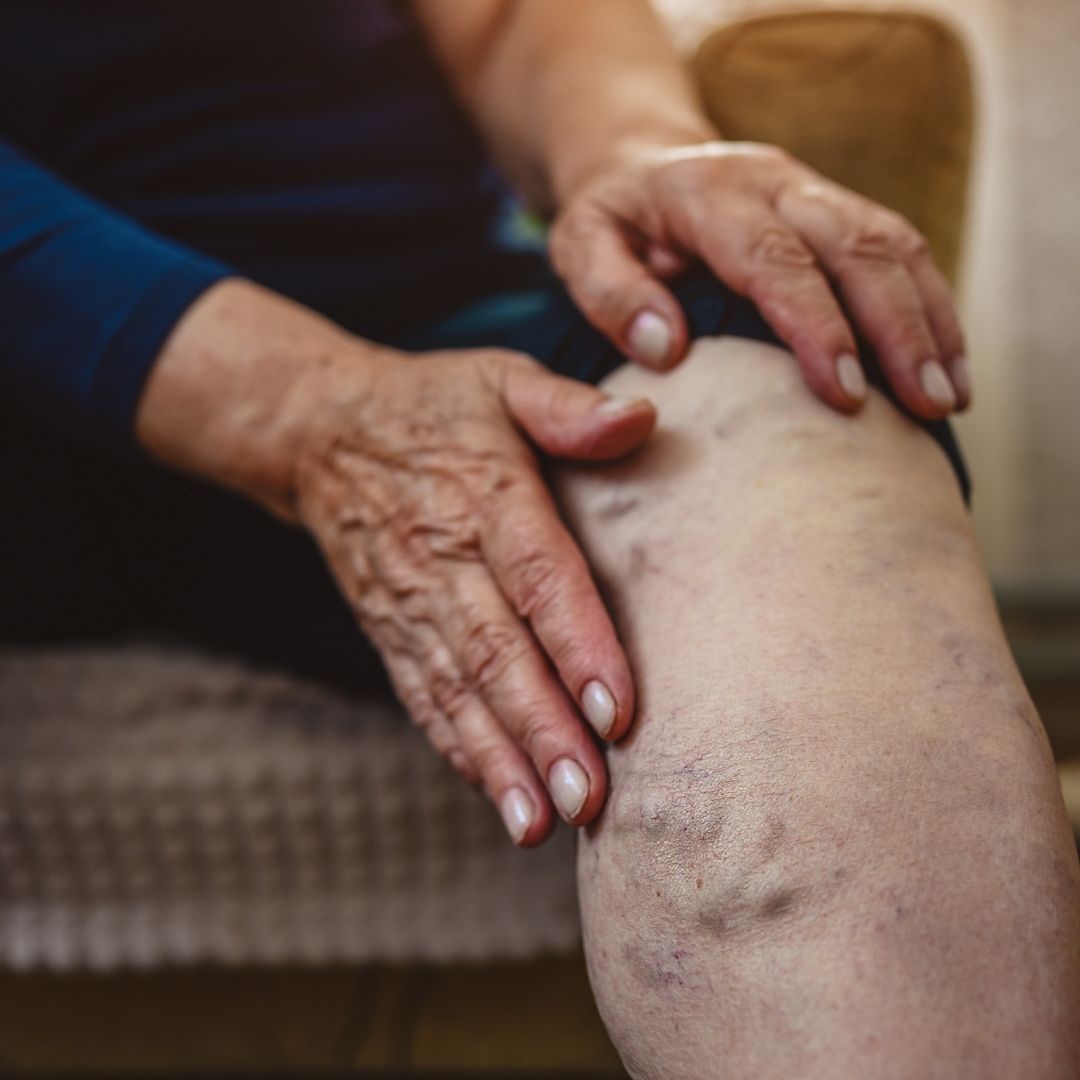 Older person seated with hands on their knee, showing bulging varicose and spider veins on the lower leg