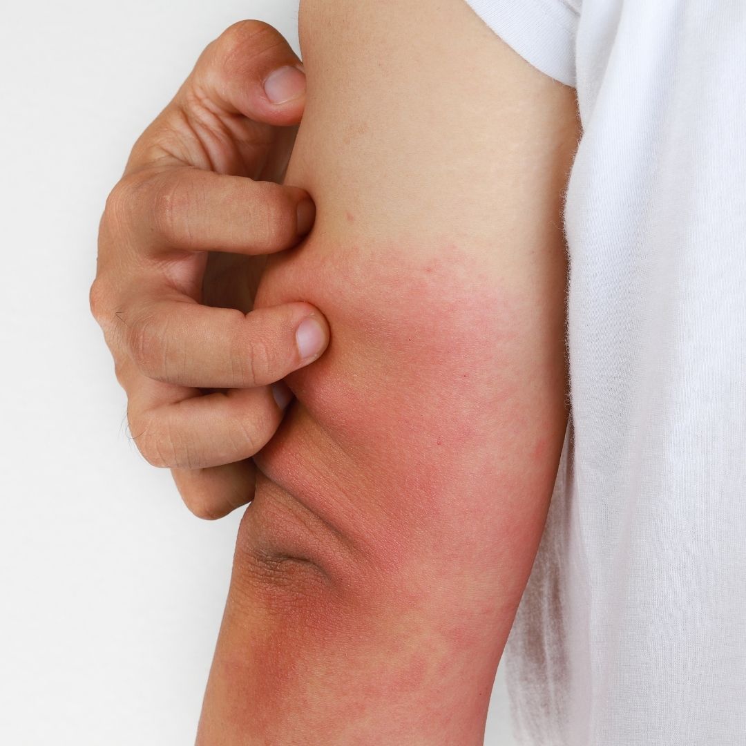Person scratching red, inflamed inner elbow rash consistent with eczema