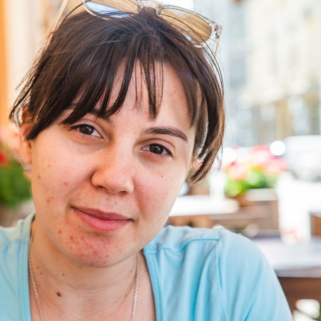 Close-up of young woman with mild acne on cheeks and chin seated outdoors at a café