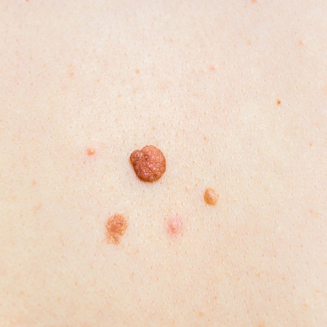 Close-up of multiple raised brown skin growths on pale skin, including one larger wrinkled papule and several smaller tags
